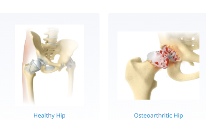anatomical model of healthy hip and osteoarthritic hip