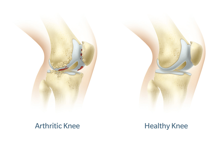 anatomical diagram of an arthritic knee and a healthy knee