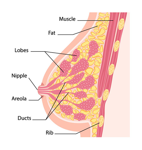 graphic diagram of a breast with a cancerous lump