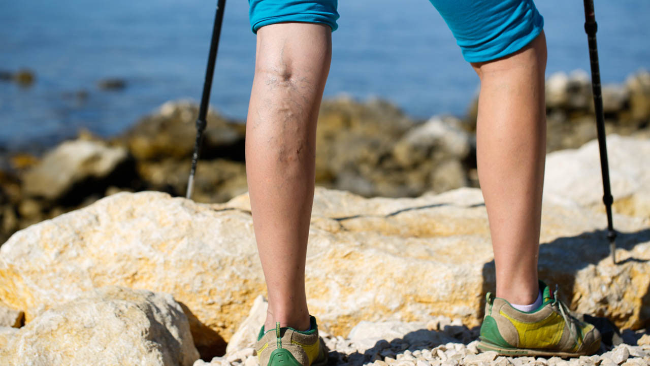 Female with varicose veins in legs walking outside